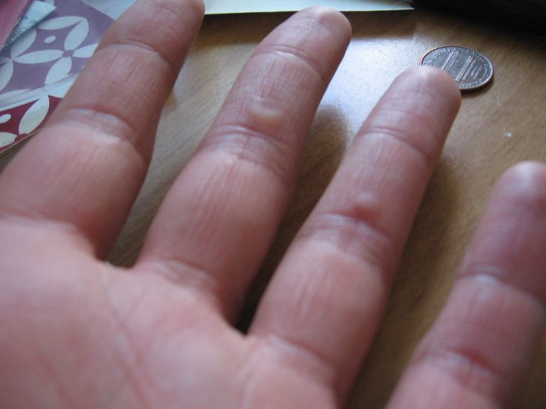 Best Precautions For Drumming Blisters In 2023